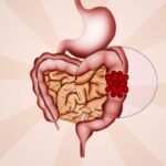 Colon Cancer