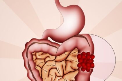 Colon Cancer