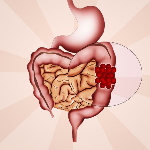 Colon Cancer