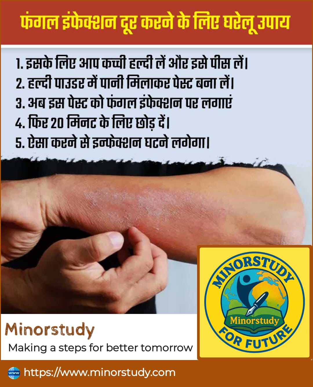 Fungal Infections