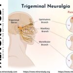 Trigeminal Neuralgia
