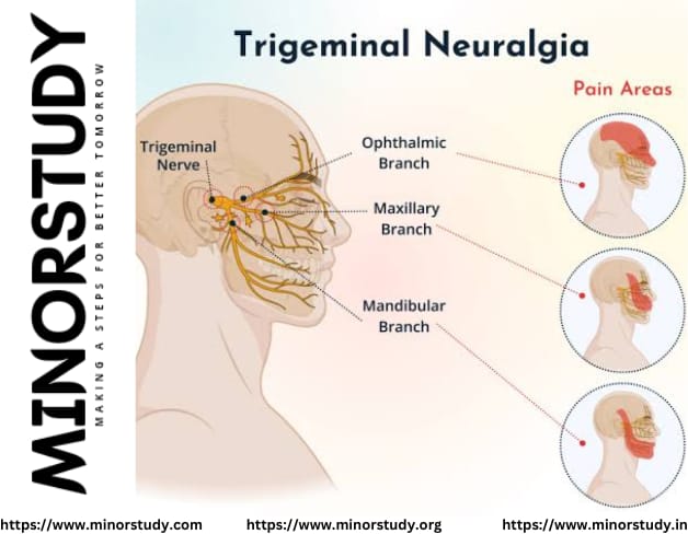 Trigeminal Neuralgia