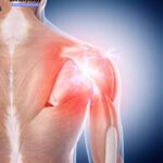 Shoulder Instability Repair