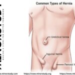 hernia