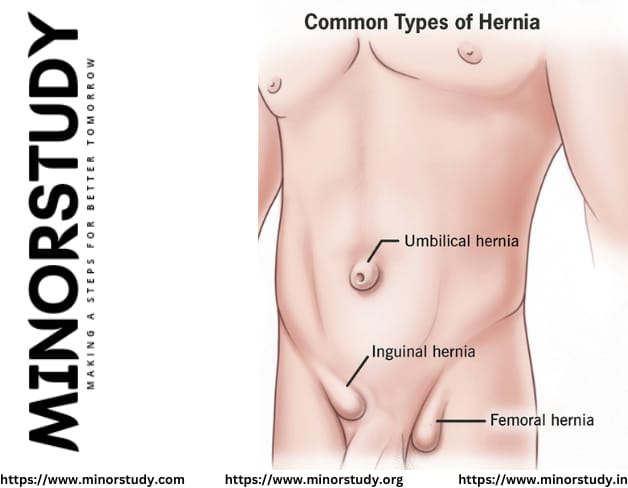 hernia
