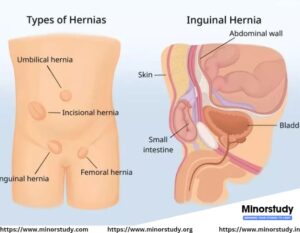hernia